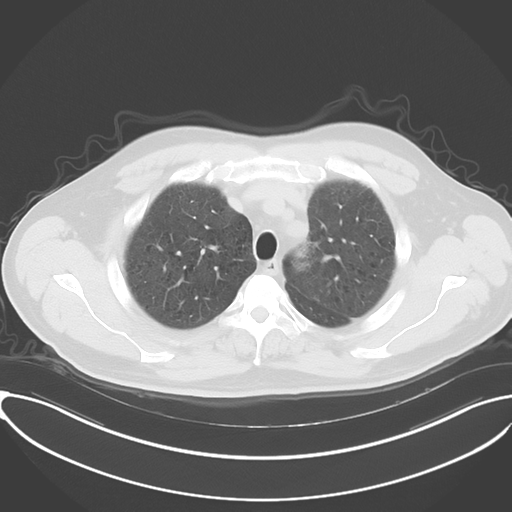 Chronic hypersensitivity pneumonitis (Radiopaedia 48107-52922 Axial lung window 17).png