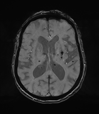 Chronic hypertensive encephalopathy (Radiopaedia 72844-83495 Axial SWI magnitude 47).png