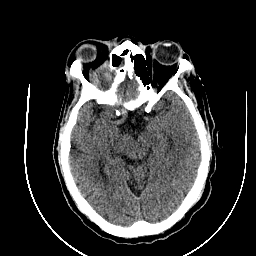 File:Chronic invasive fungal sinusitis (Radiopaedia 91563-109286 Axial non-contrast 44).jpg