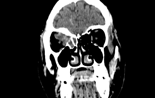 Chronic invasive fungal sinusitis (Radiopaedia 91563-109286 D 28).jpg
