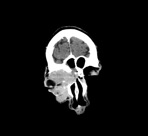 Chronic invasive fungal sinusitis with intraorbital and intracranial extension (Radiopaedia 56387-63046 C 53).jpg