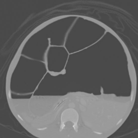 Chronic large bowel pseudo-obstruction (Radiopaedia 43181-46492 Axial bone window 75).jpg