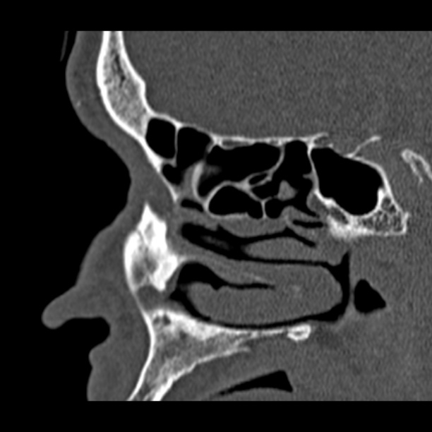 Chronic maxillary sinusitis (Radiopaedia 27879-28116 Sagittal bone window 35).jpg