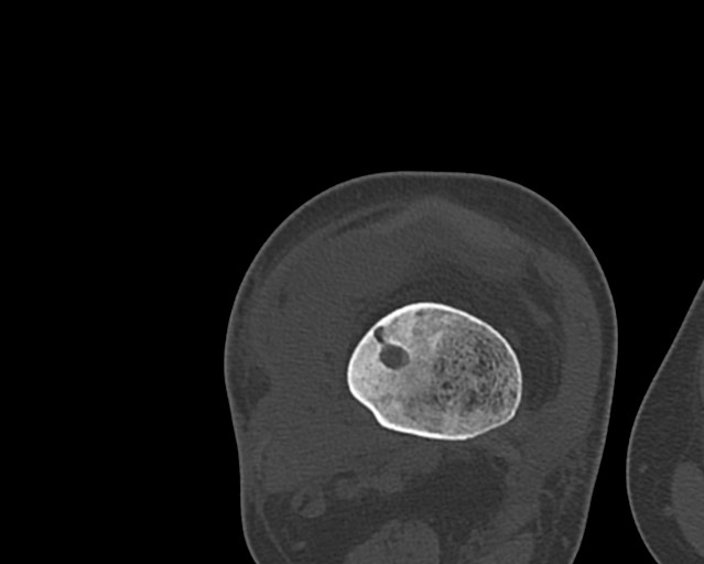 Chronic ostemyelitis of the femur with long sinus tract (Radiopaedia 74947-85982 Axial bone window 192).jpg