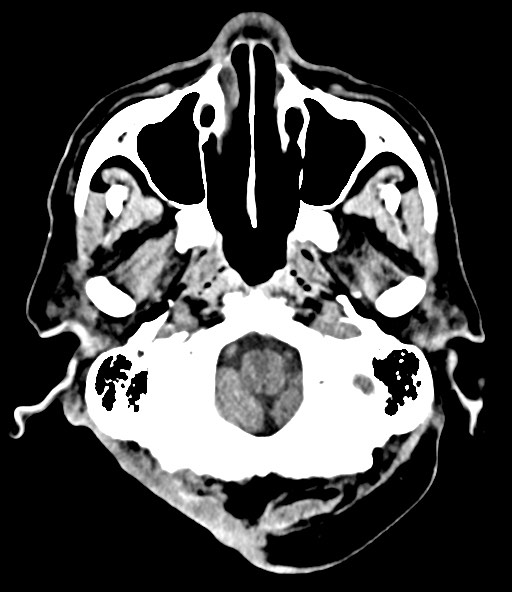 File:Chronic osteomyelitis - calvarial (severe) (Radiopaedia 69668-79616 Axial non-contrast 27).jpg