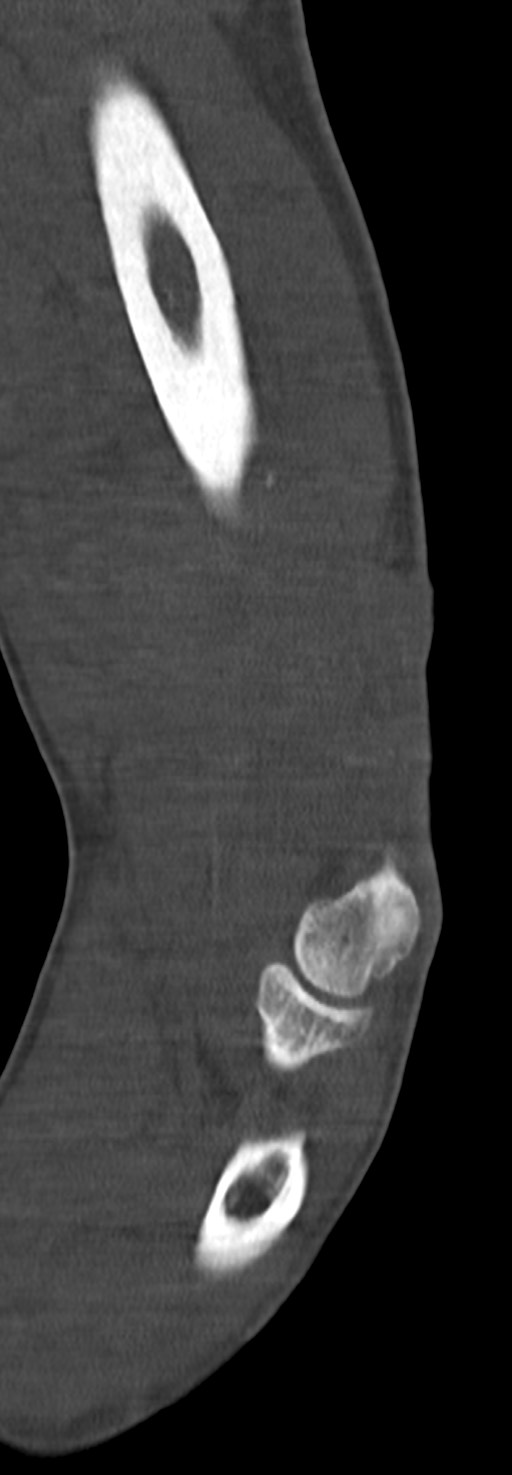 Chronic osteomyelitis of the distal humerus (Radiopaedia 78351-90971 Sagittal bone window 44).jpg