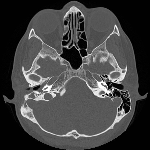 File:Chronic otomastoiditis (Radiopaedia 27138-27309 Axial bone window 28).jpg