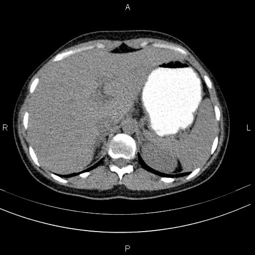 File:Chronic pancreatitis (Radiopaedia 64576-73450 Axial non-contrast 26).jpg