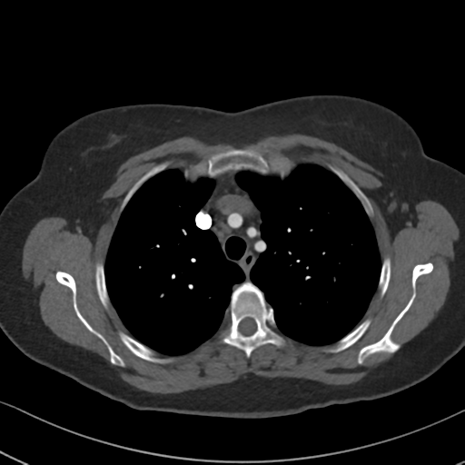 File:Chronic pulmonary embolus (Radiopaedia 39129-41341 Axial C+ CTPA 28).png