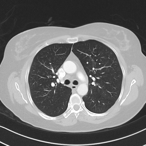 Chronic pulmonary embolus (Radiopaedia 39129-41341 Axial lung window 25).png