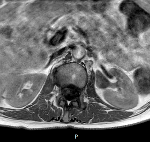 File:Chronic spinal hematoma with cauda equina syndrome (Radiopaedia 75745-87090 Axial T1 1).png