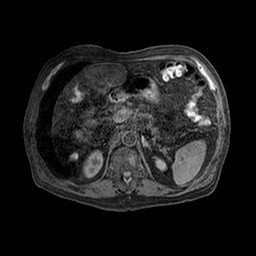 Cirrhosis and hepatocellular carcinoma in the setting of hemochromatosis (Radiopaedia 75394-86594 Axial T1 C+ fat sat 39).jpg