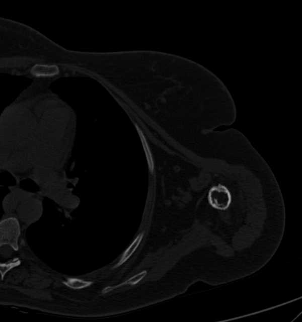 Clear cell chondrosarcoma - humerus (Radiopaedia 63104-71612 Axial bone window 74).jpg