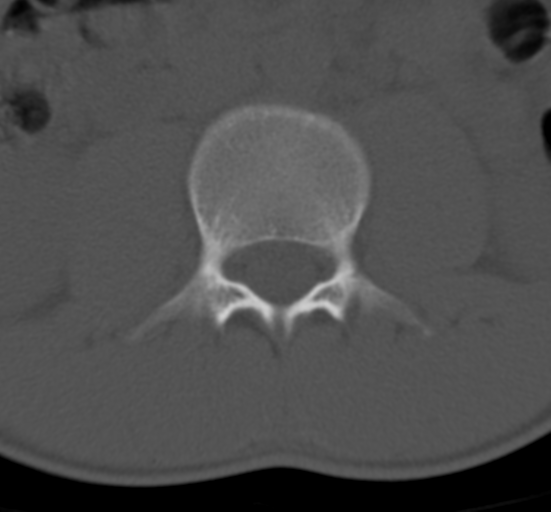 Clear cell meningoma - lumbar spine (Radiopaedia 60116-67691 Axial bone window 28).png