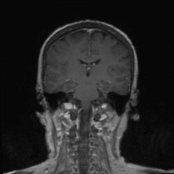 File:Clival meningioma (Radiopaedia 53278-59248 F 17).jpg