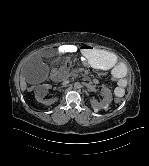 Closed-loop small bowel obstruction-internal hernia (Radiopaedia 78439-91096 Axial non-contrast 62).jpg