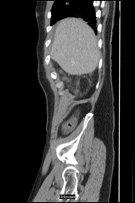Closed loop bowel obstruction and ischemia (Radiopaedia 86959-103180 C 60).jpg