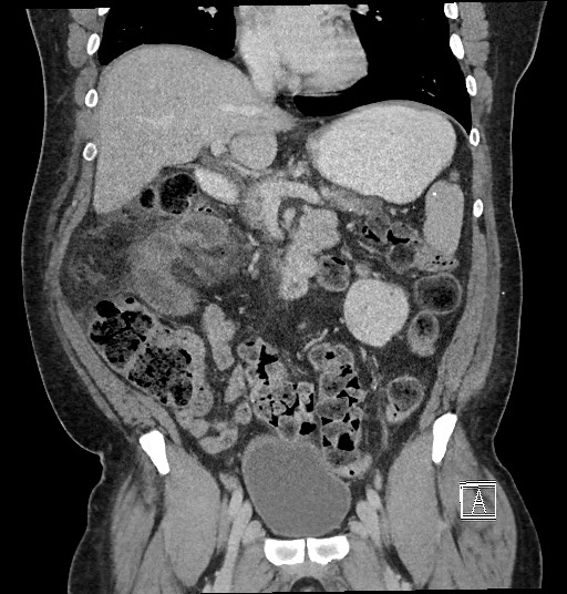 File:Closed loop obstruction - internal hernia into nephrectomy bed (Radiopaedia 59867-67320 B 61).jpg