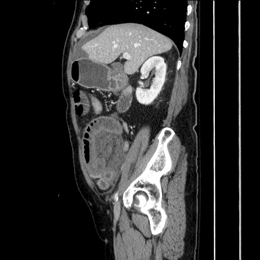 File:Closed loop obstruction due to adhesive band, resulting in small bowel ischemia and resection (Radiopaedia 83835-99023 F 65).jpg