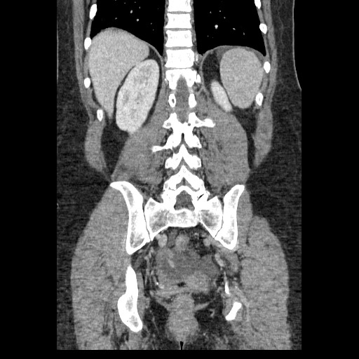 Closed loop small bowel obstruction (Radiopaedia 65403-74451 B 79).jpg