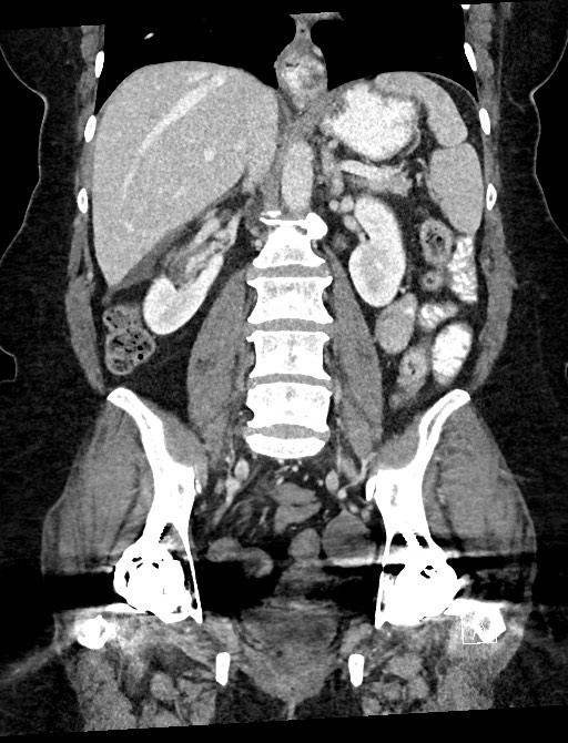 Closed loop small bowel obstruction - adhesions (Radiopaedia 59078-66369 B 73).jpg