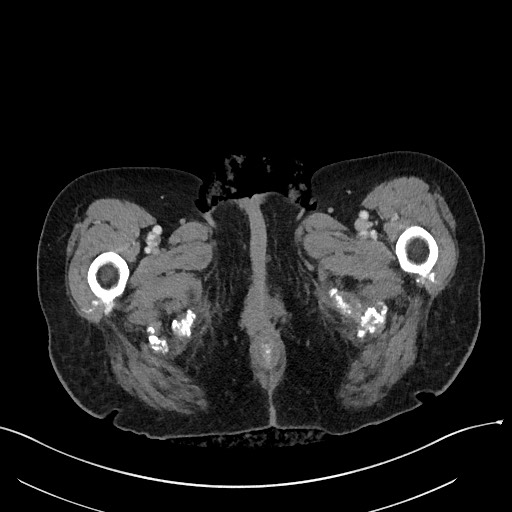Closed loop small bowel obstruction - adhesions (Radiopaedia 59269-66611 A 150).jpg