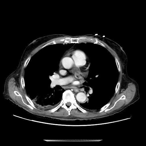 Closed loop small bowel obstruction - adhesive disease and hemorrhagic ischemia (Radiopaedia 86831-102990 A 5).jpg