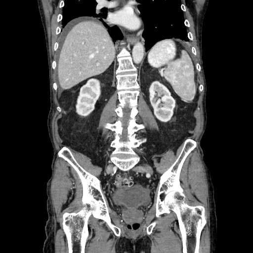 Closed loop small bowel obstruction - adhesive disease and hemorrhagic ischemia (Radiopaedia 86831-102990 B 85).jpg