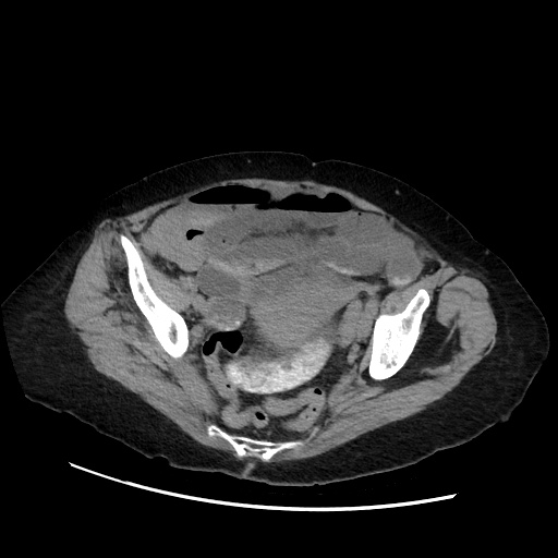 Closed loop small bowel obstruction due to adhesive band, with intramural hemorrhage and ischemia (Radiopaedia 83831-99017 Axial non-contrast 132).jpg