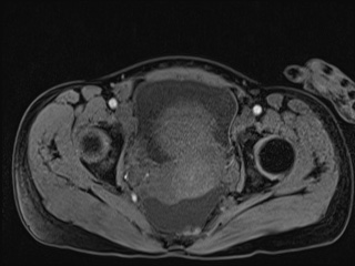 Closed loop small bowel obstruction in pregnancy (MRI) (Radiopaedia 87637-104031 G 14).jpg