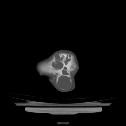 Cloverleaf skull (Radiopaedia 91901-109710 Axial bone window 138).jpg