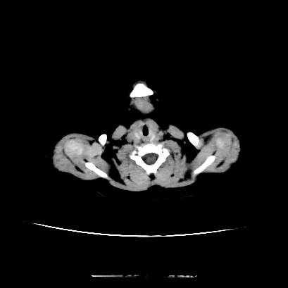 Cloverleaf skull (Radiopaedia 91901-109710 Axial non-contrast 12).jpg