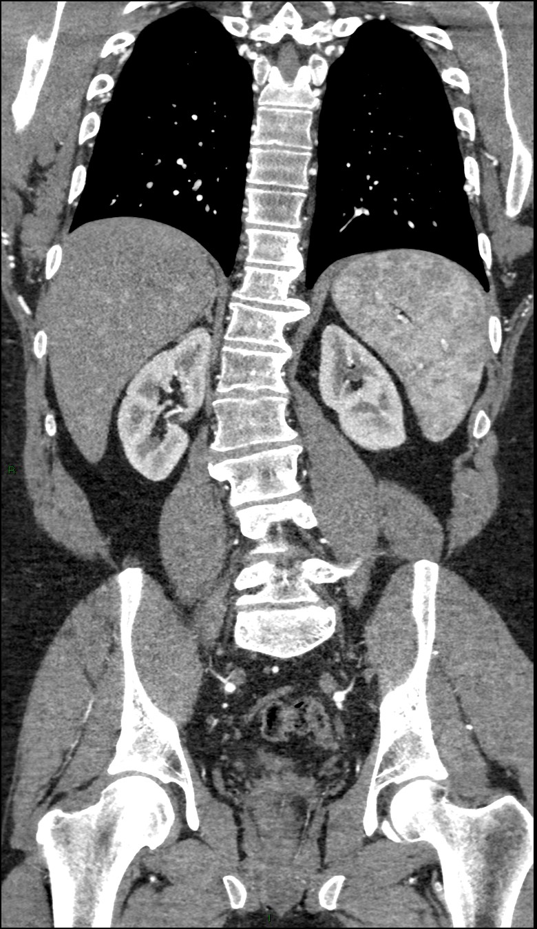 Coarctation of the aorta (Radiopaedia 74632-88521 B 168).jpg