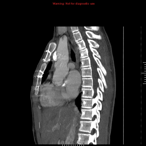 File:Coarctation of the aorta (Radiopaedia 9434-10118 B 25).jpg