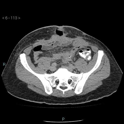 File:Colo-cutaneous fistula (Radiopaedia 40531-43129 A 47).jpg