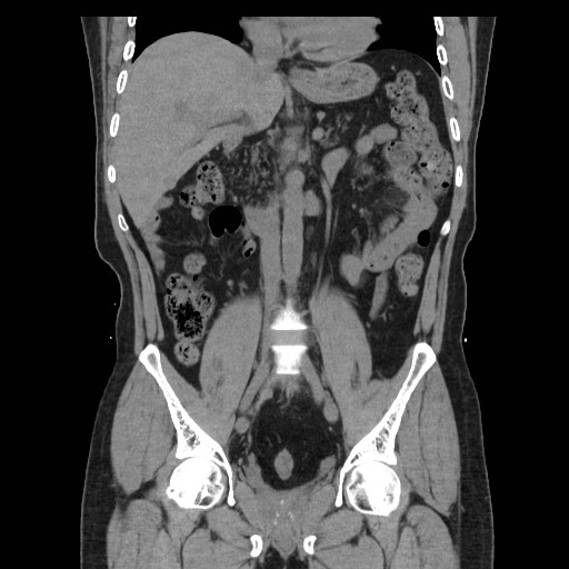 File:Colocutaneous fistula in Crohn's disease (Radiopaedia 29586-30093 Coronal non-contrast 17).jpg