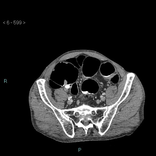 File:Colonic cancer (ultrasound and TC imaging) (Radiopaedia 50346-55713 A 102).jpg