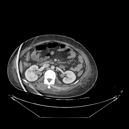 Colonic infarction after colostomy creation (Radiopaedia 81157-94797 A 71).jpg