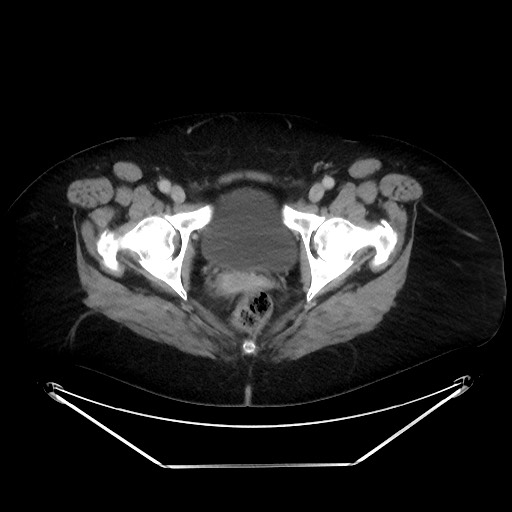 File:Colonic intussusception due to adenocarcinoma (Radiopaedia 86828-102987 A 142).jpg