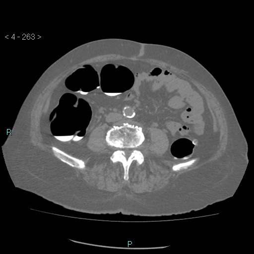 File:Colonic lipomas (Radiopaedia 49137-54244 Axial bone window 117).jpg