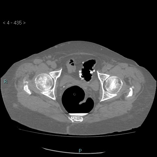 File:Colonic lipomas (Radiopaedia 49137-54244 Axial bone window 193).jpg