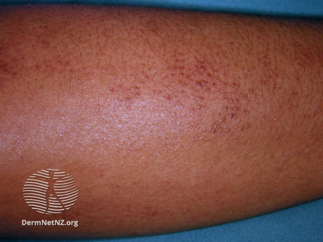 File:Lichen amyloidosis 05 (DermNet NZ lichen-amyloidosis-05).jpg