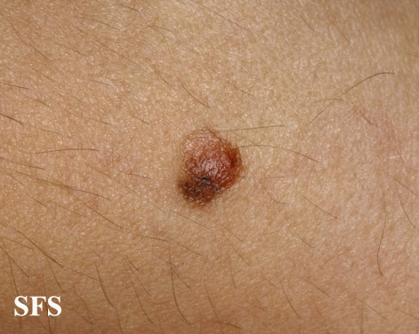 File:Melanoma (Dermatology Atlas 32).jpg