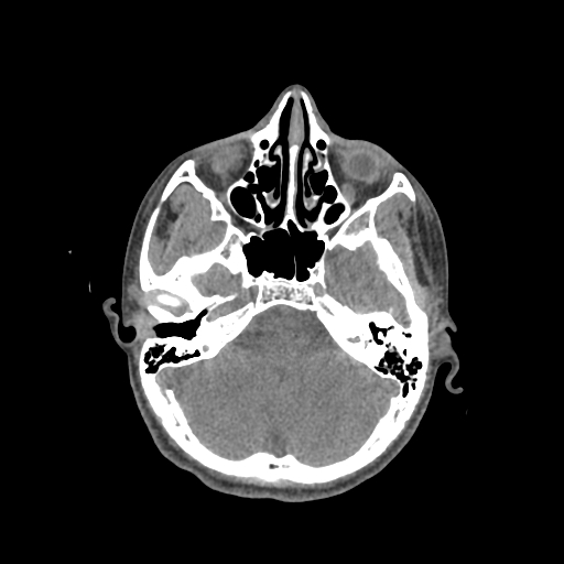 Nasal pyogenic granuloma (lobular capillary hemangioma) (Radiopaedia 85536-101244 Axial non-contrast 83).jpg