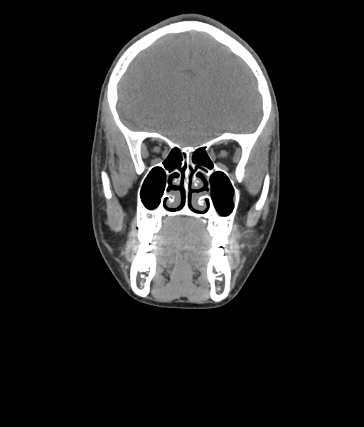 File:Nasal pyogenic granuloma (lobular capillary hemangioma) (Radiopaedia 85536-101244 Coronal non-contrast 93).jpg