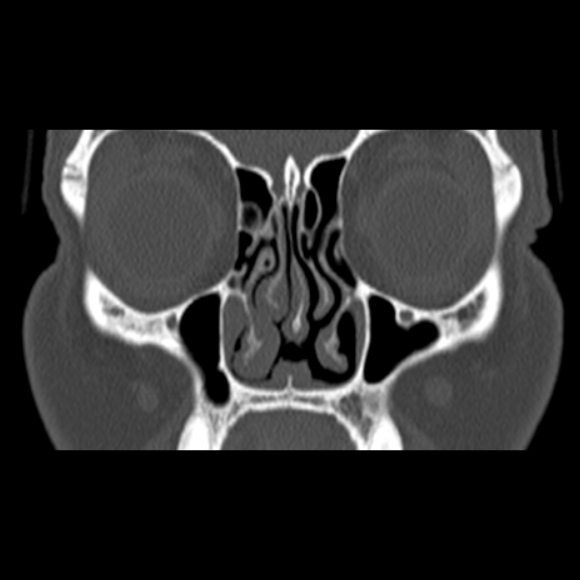 Nasal septal perforation (Radiopaedia 25030-25289 Coronal bone window 26).jpg