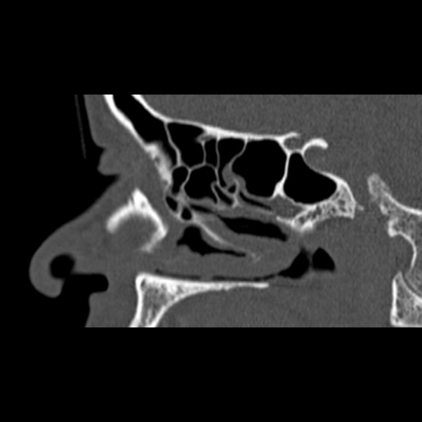 Nasal septal perforation (Radiopaedia 25030-25289 Sagittal bone window 14).jpg