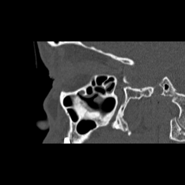 Nasal septal perforation (Radiopaedia 25030-25289 Sagittal bone window 51).jpg