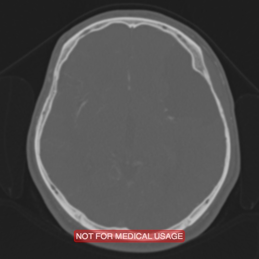 Nasopharyngeal carcinoma recurrence - skull base destruction (Radiopaedia 29107-29490 Axial bone window 55).jpg
