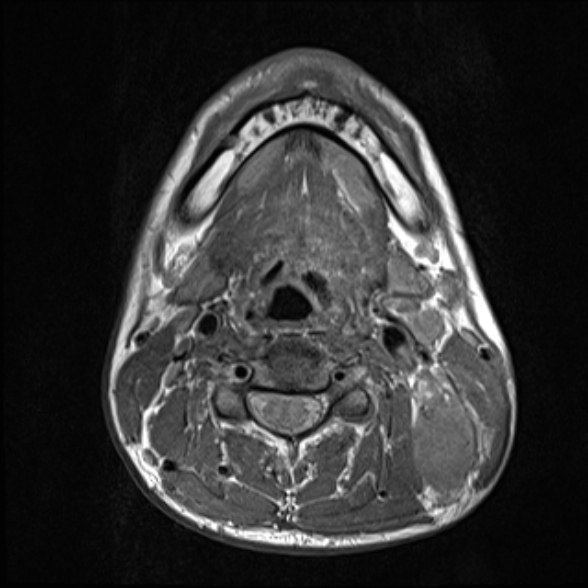 Nasopharyngeal carcinoma with skull base invasion (Radiopaedia 53415-59485 Axial T1 49).jpg
